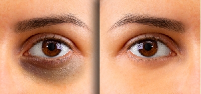 Quầng thâm mắt sẽ dễ dàng bị đánh bay - uầng thâm thường được cho là do căng thẳng, mệt mỏi và quá trình lão hóa tự nhiên. Tuy nhiên, các yếu tố khác có thể xảy ra, bao gồm di truyền, chế độ ăn uống, hút thuốc và rượu. Nhóm chuyên 