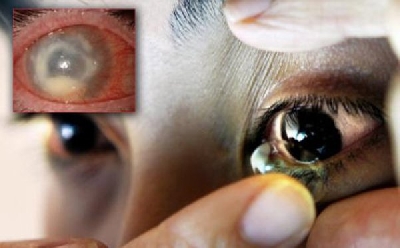 Sai lầm khi dùng kính áp tròng sai cách - h, đeo kính không đúng cách sẽ gây ra những vấn đề bệnh lý về mắt.

Sử dụng các loại kính không đạt tiêu chuẩn
Sử dụng các loại kính áp tròng giá rẻ, không rõ nguồn gốc xuất xứ là nguy