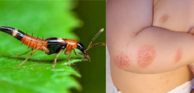 images/thumbnail/tim-hieu-vet-thuong-do-kien-ba-khoang-can-va-cach-xu-tri_tbn_1672815905.jpg