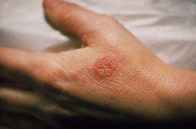Xử lý làn da bị chàm mức độ nhẹ - uẩn bị những tips bảo vệ da trước khi trời trở lạnh. Nhất là người bệnh chàm, vì đây sẽ là máy chà sàn liên hợpmột mùa không mấy dễ chịu bởi những đợt bùng phát cơn ngứa dữ dội.

Th